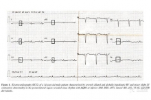 JCE:碎裂QRS波可预测致心律失常性右室心肌病患者心律失常事件的发生 ...