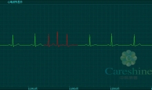 产品体验活动发现短阵室上性心动过速案例