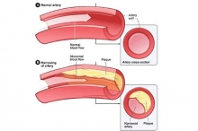 粥样硬化斑块破裂风险评估有新法