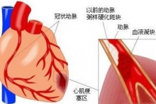 心电图查出心肌缺血时怎么办？专家：避免诱发因素