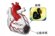 大咖的无形杀手—心肌梗死的二三事