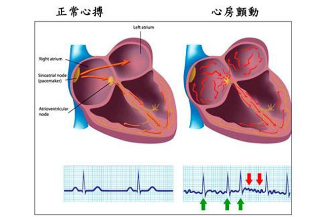 心律失常革命性突破:心脏性猝死和房颤十年研究进展概述